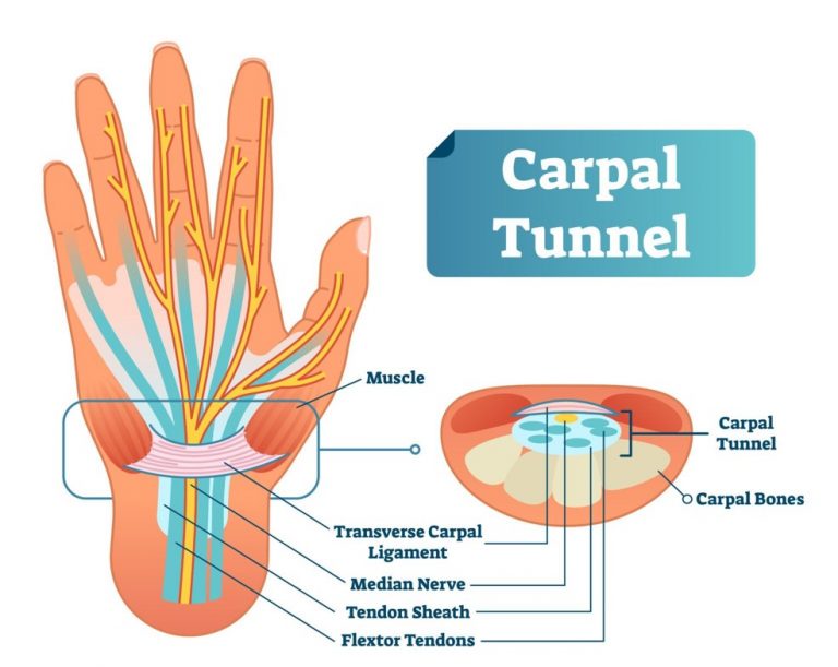 Understanding Carpal Tunnel Syndrome Ridgefieldchiropractic