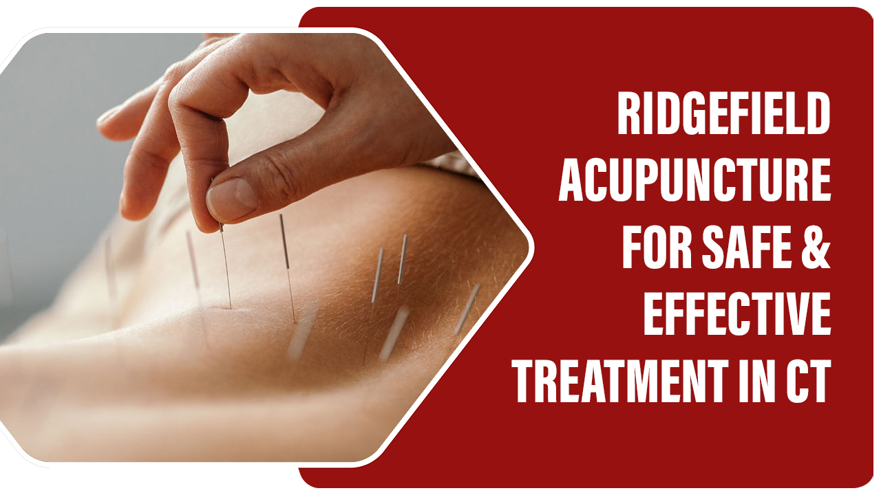 Ridgefield acupuncture