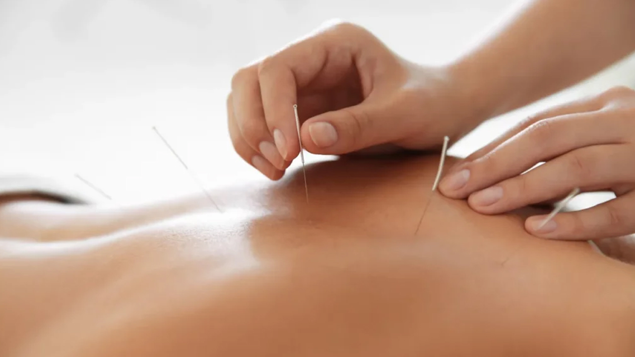 Ridgefield acupuncture